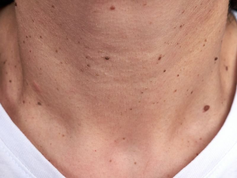 Verrugas Cuello